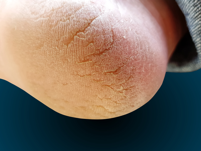 Patient showing her heel with fissures Patient showing her heel with fissures