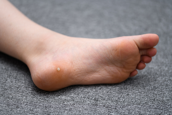 Verruca on sole of foot Verruca on sole of foot