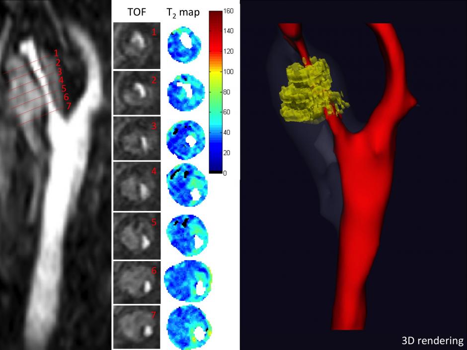Carotid MRI T2 mapping