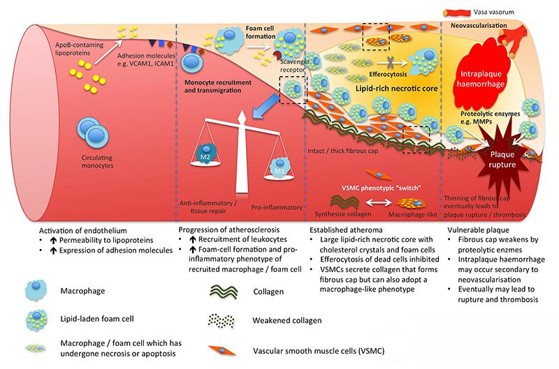 Atherosclerosis drawing showing cellular accumulation and lipid rich necrotic core