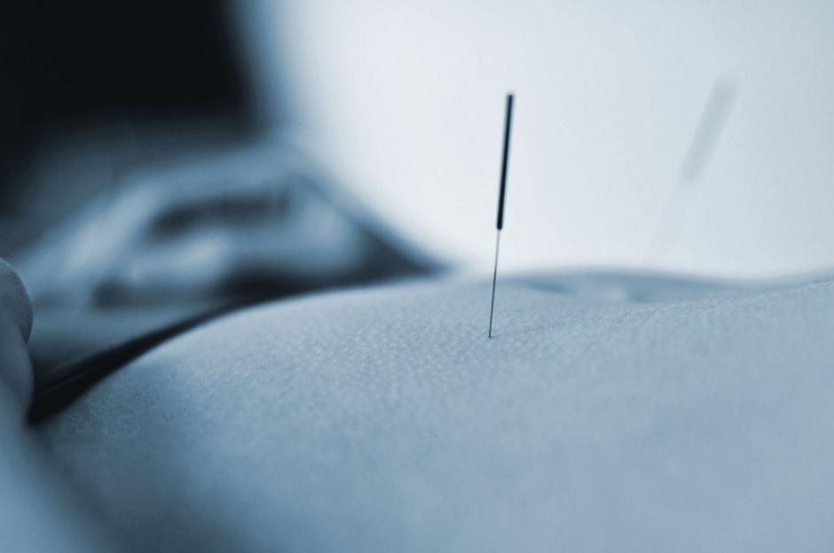 Acupuncture needle in back