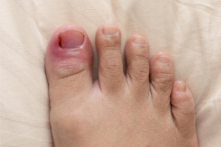 Painful infected ingrowing toenails