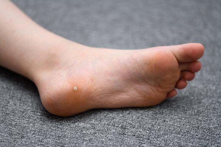 Verruca on sole of foot Verruca on sole of foot