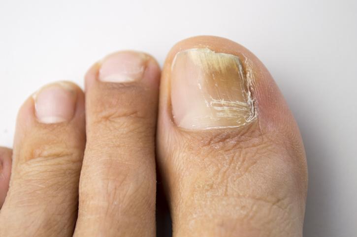 Nail fungal infection