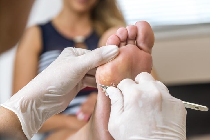 Female patients having corns and calluses treatment Female patients having corns and calluses treatment