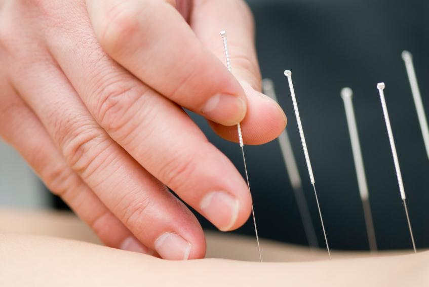 Acupuncture needle in the back