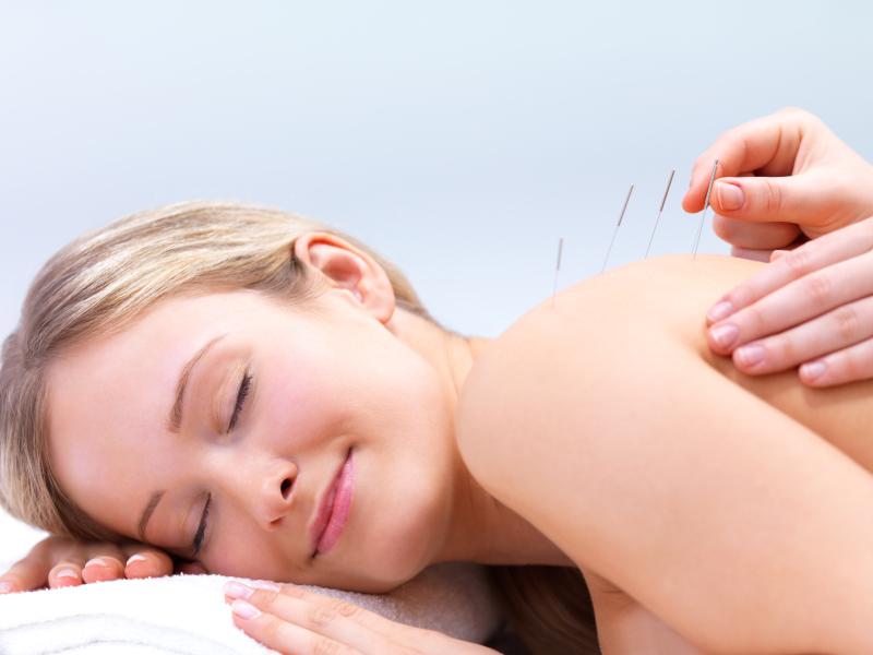 Female patient having acupuncture dry needling treatment